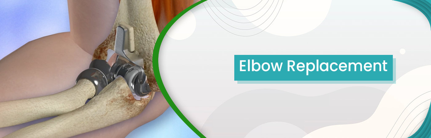 Elbow Replacement Elbow Replacement