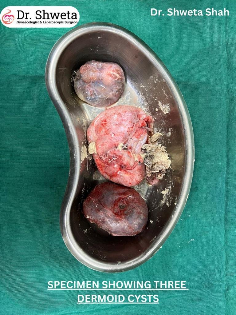 Dermoid Cysts Dermoid Cysts