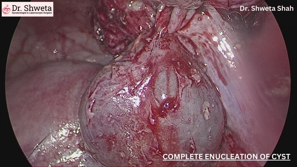 Enucleation of Cysts Enucleation of Cysts