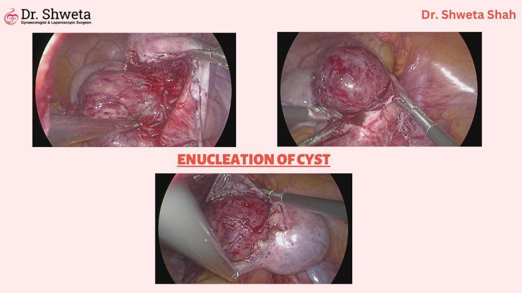 Enucleation of Cysts Enucleation of Cysts