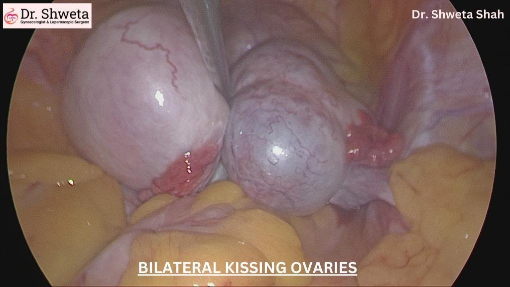 ovaries ovaries