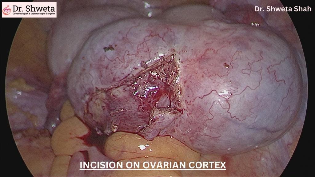 OVARIES OVARIES