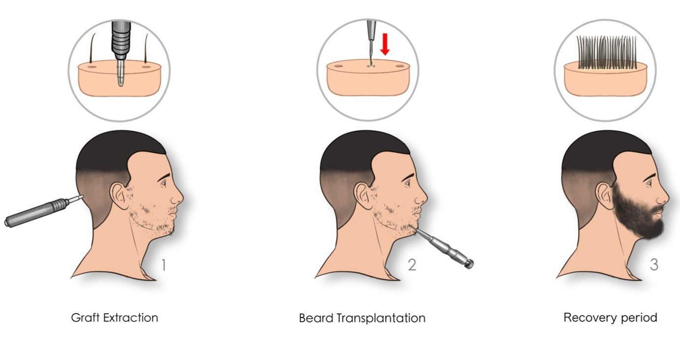 Beard & Moustache Transplant Turkey | Procedure & Costs 2022