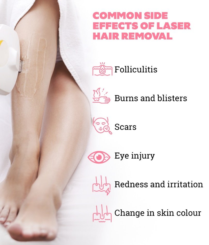 laser hair removal