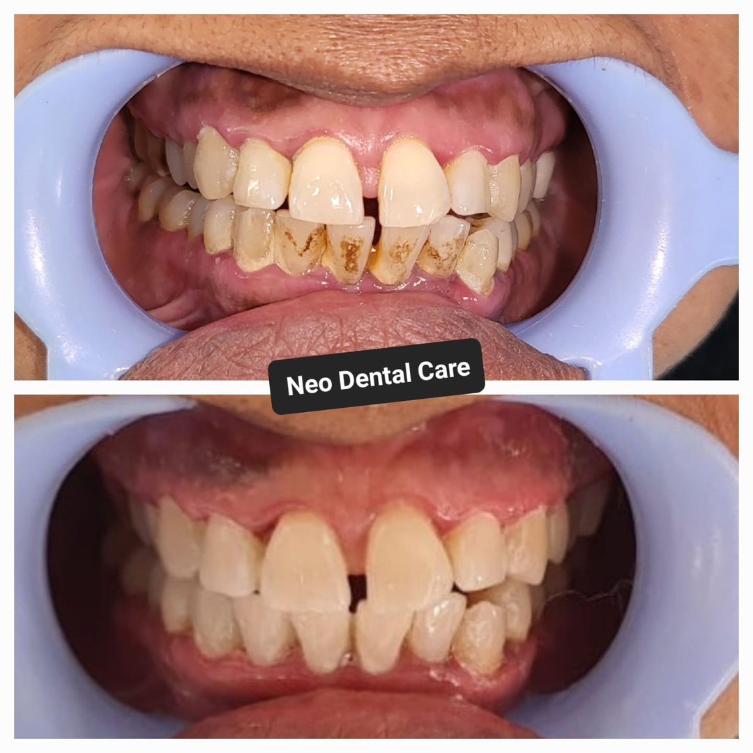 Laser teeth whitening Laser teeth whitening
