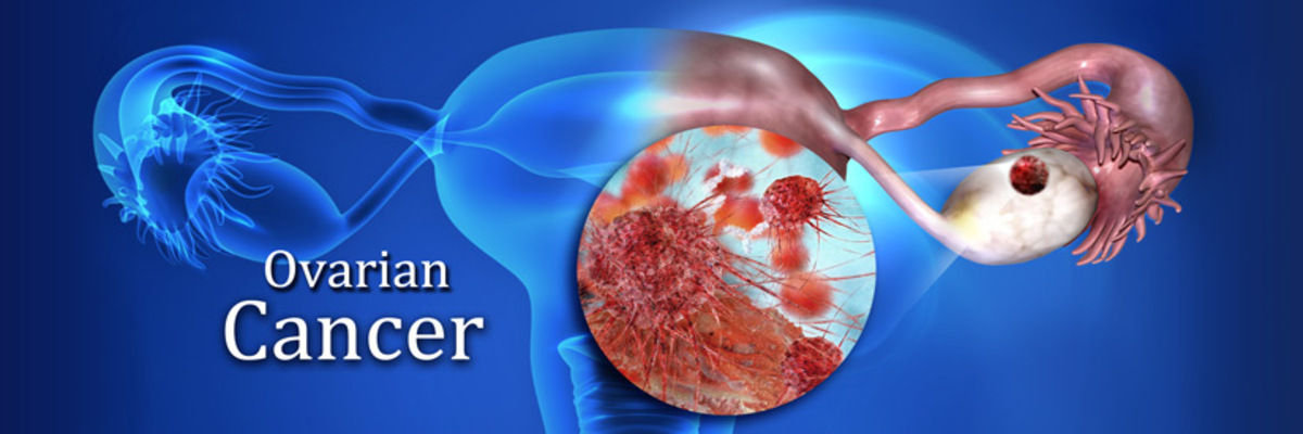 Ovarian Cancer Ovarian Cancer