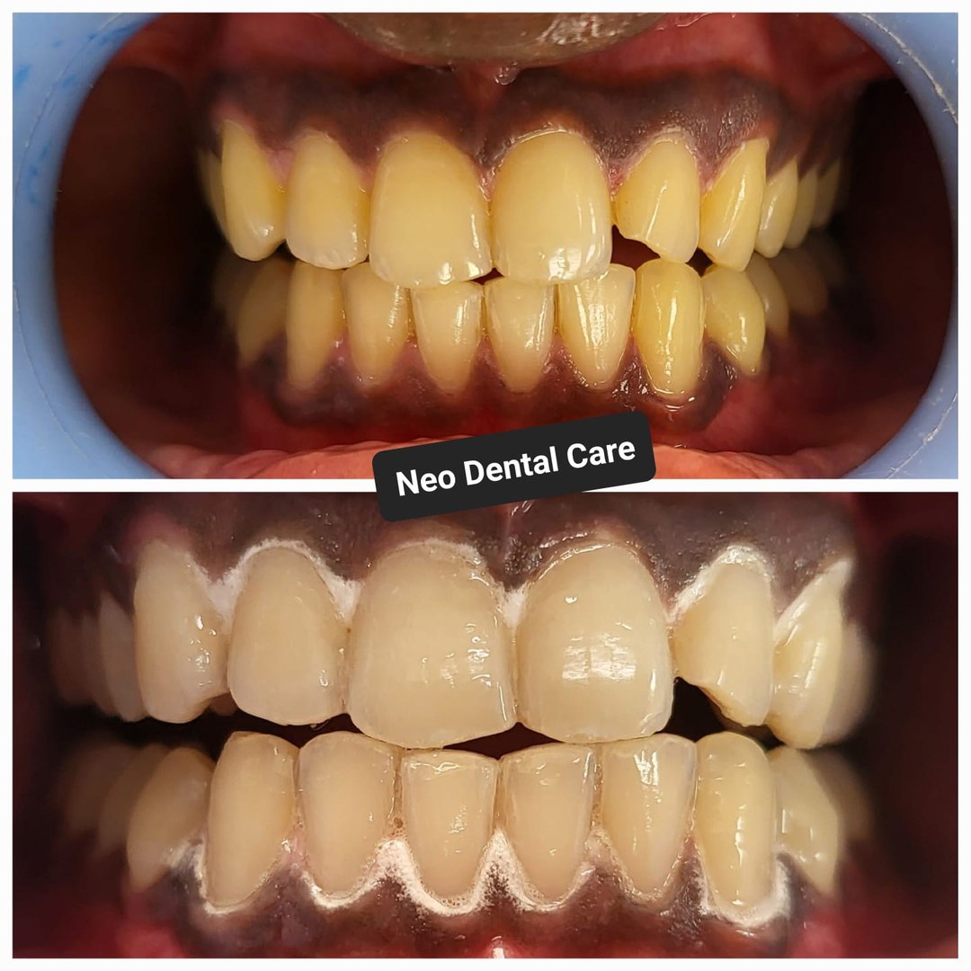 Single visit teeth whitening Single visit teeth whitening