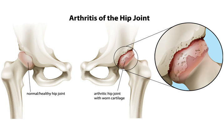 Hip Arthritis: Symptoms, Causes and Treatment | Health Plus