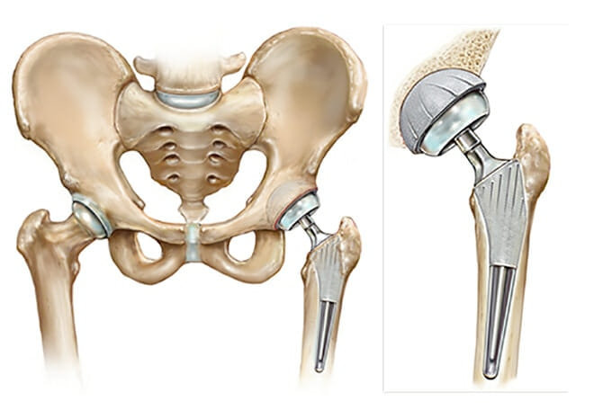 Total Hip Replacement - OM SURGICAL HOSPITAL & TRAUMA CENTRE., Nagpur