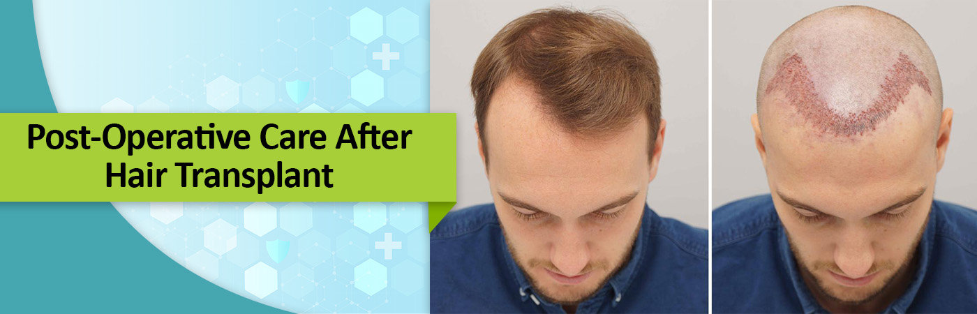 Hair transplant timeline discover the evolution month by month