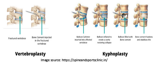 Back Surgery