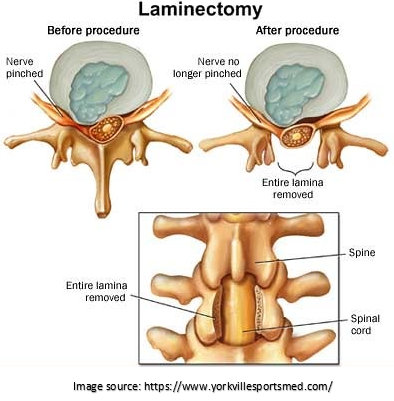 Kyphoplasty 