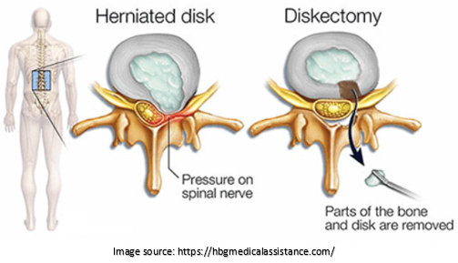 Spinal decompression