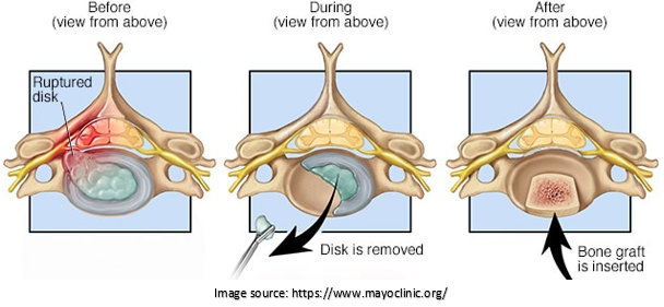 lower back pain