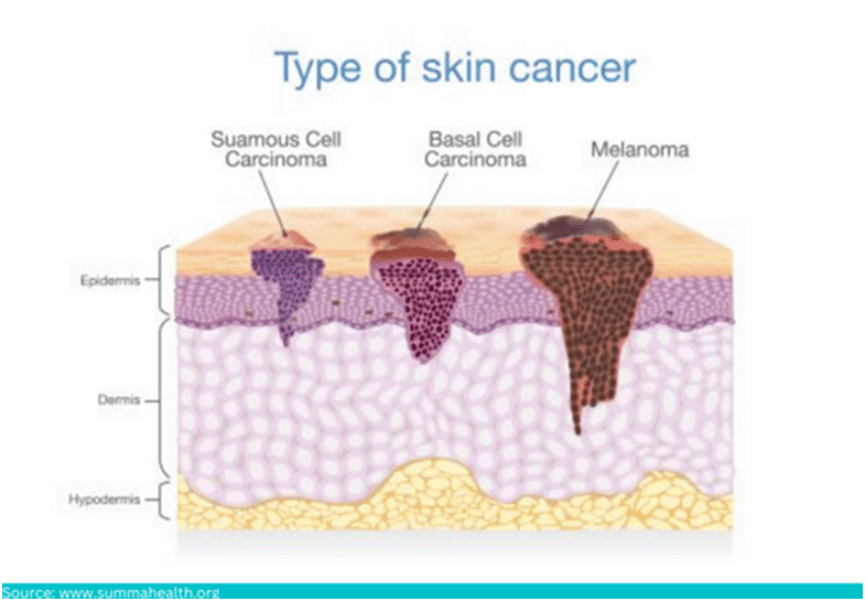  skin cancer