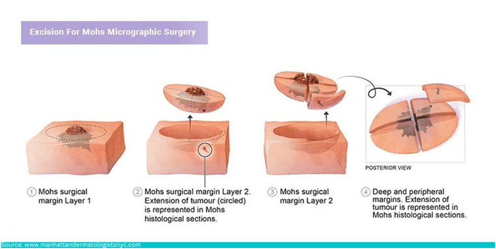 Excisional surgery