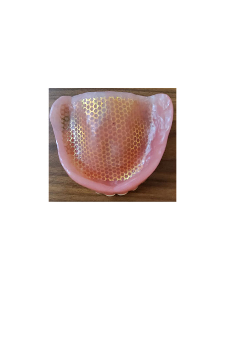 Metal reinforced dentures Metal reinforced dentures