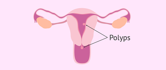  Uterine Polyps