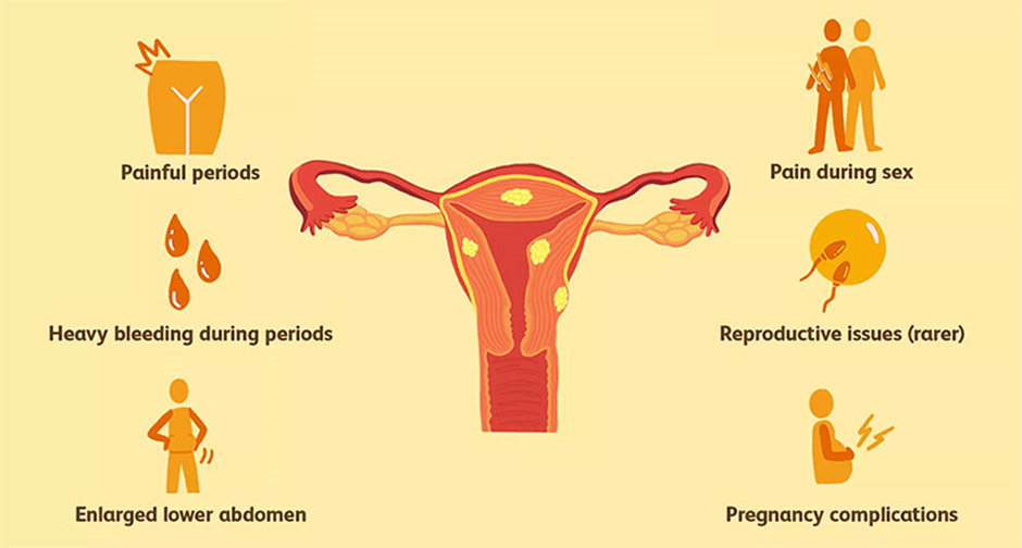 Uterine Polyps 