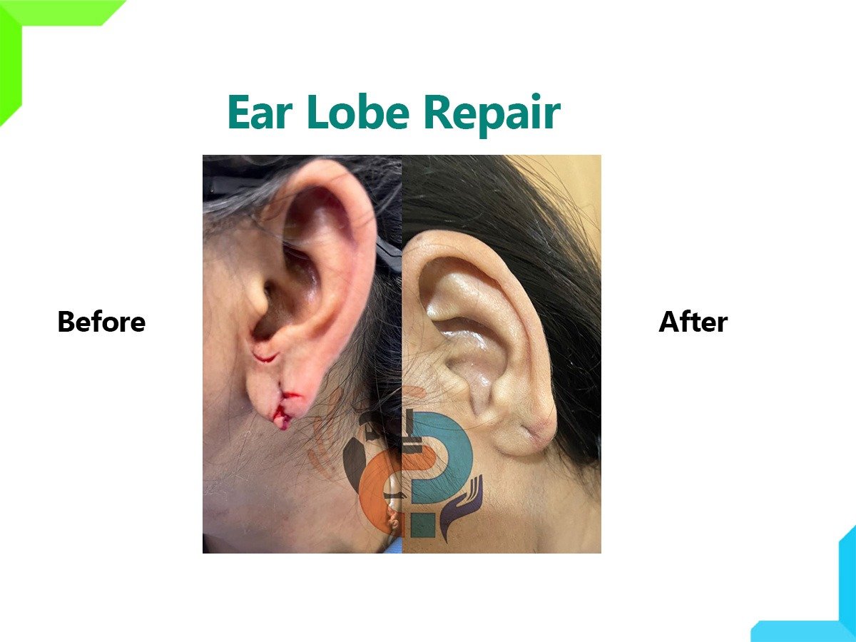 Ear lobe Repair Ear lobe Repair
