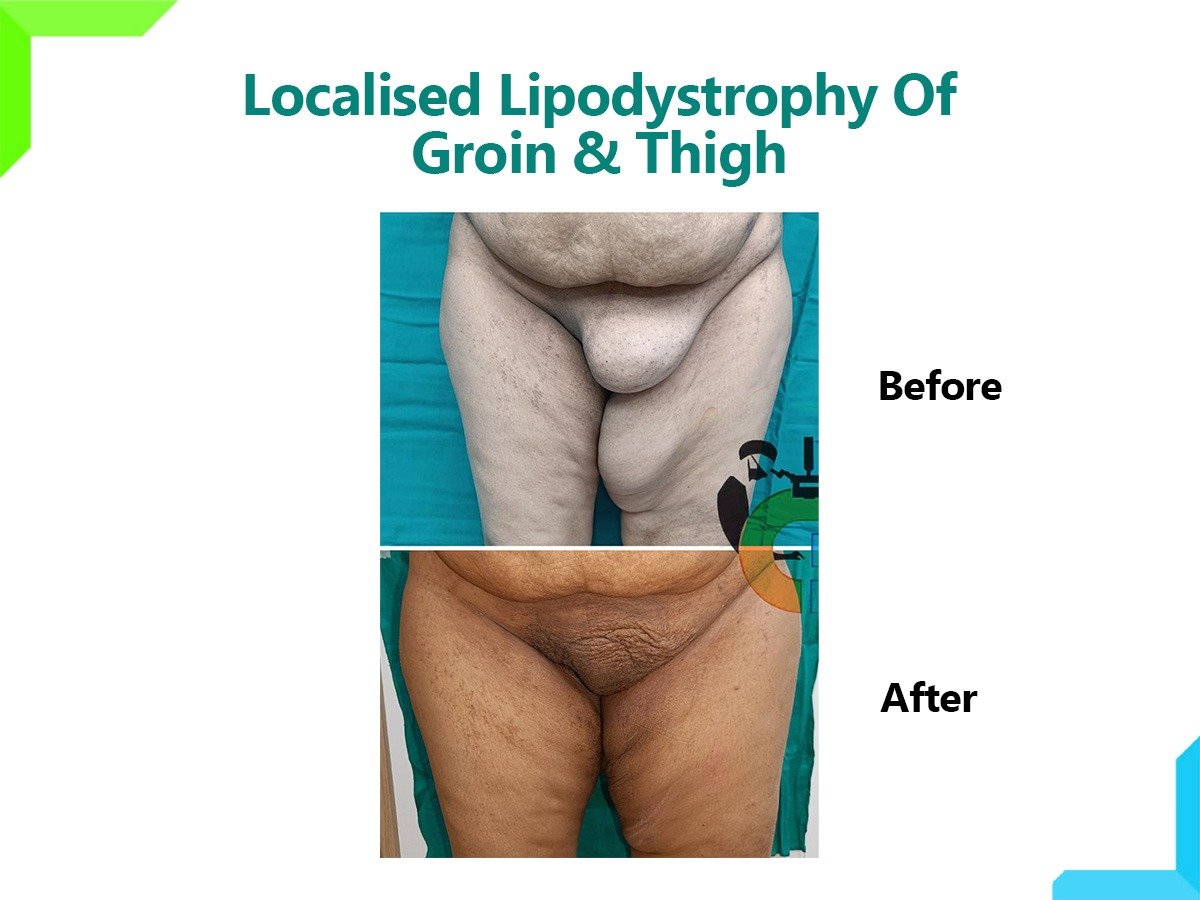 Localized Lipodystrophy Localized Lipodystrophy