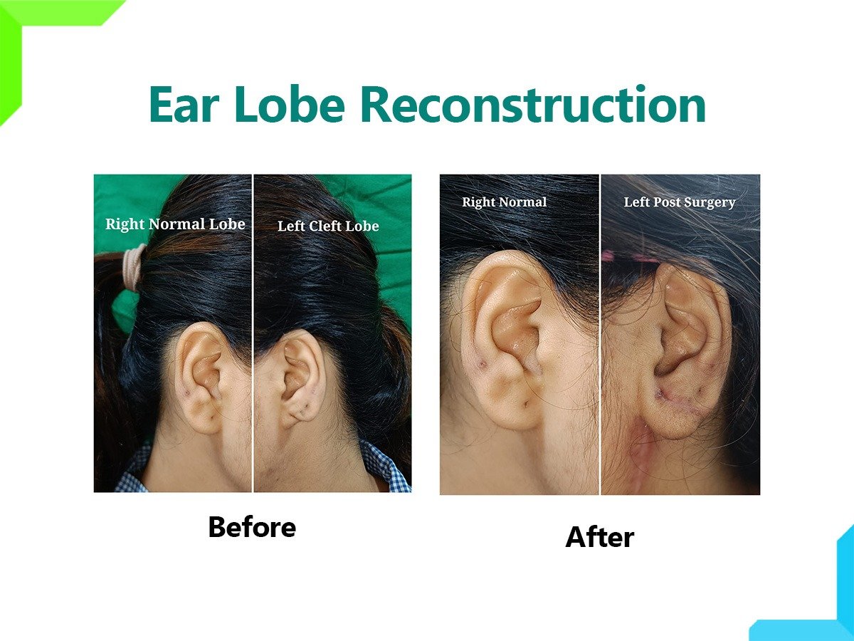 Ear lobe Reconstruction Ear lobe Reconstruction