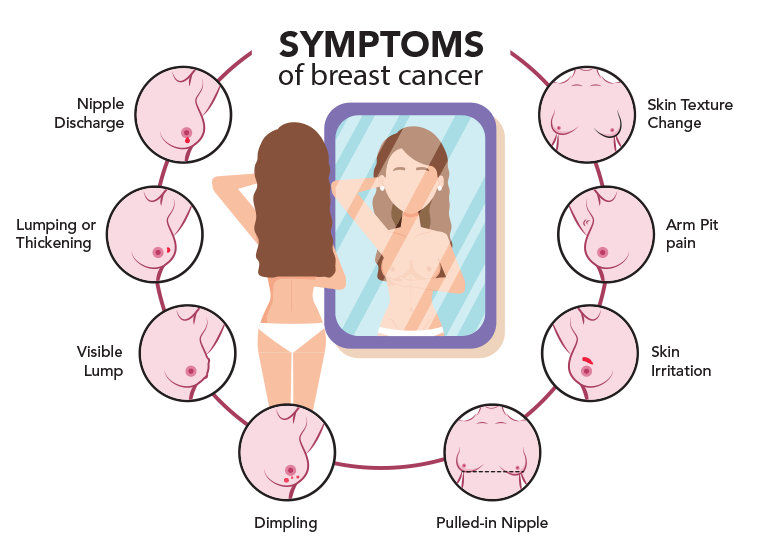 What Are the Symptoms and Signs of Breast Cancer?