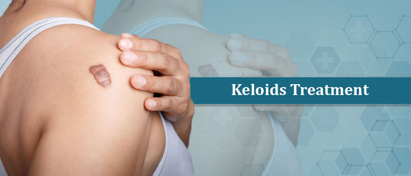 Keloids Treatment Keloids Treatment