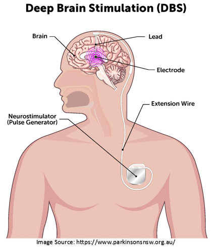 Deep Brain Stimulation surgery