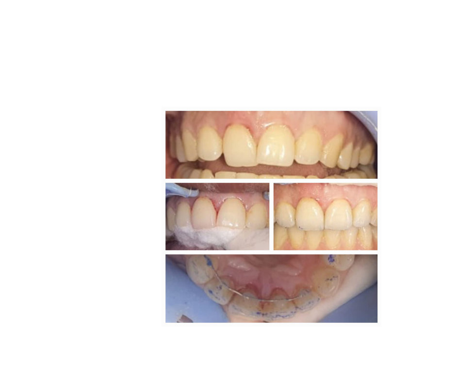 Traumatic intrusion and tilting of tooth corrected with soft splint Traumatic intrusion and tilting of tooth corrected with soft splint