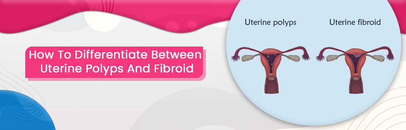 Uterine Polyps And Fibroid Uterine Polyps And Fibroid