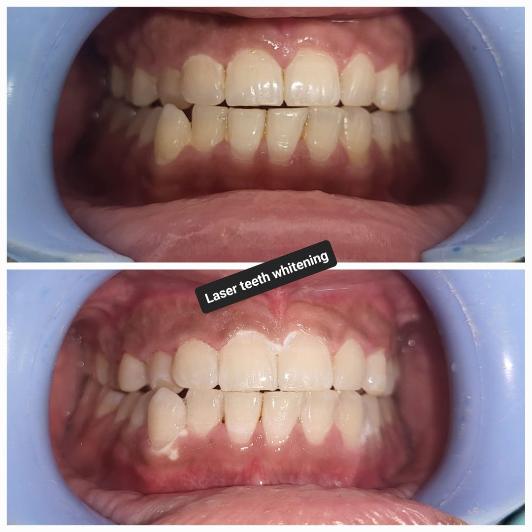 Single sitting laser teeth whitening Single sitting laser teeth whitening