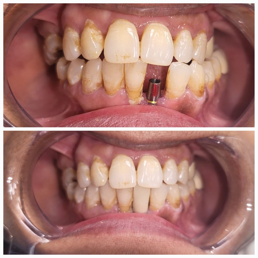 Lower single tooth replacement with dental implant Lower single tooth replacement with dental implant