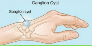 Ganglion cyst