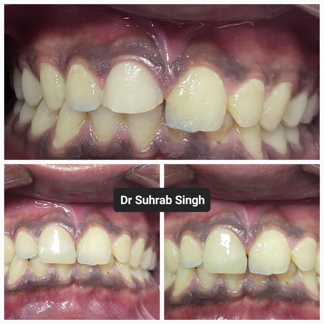 Lithium disilicate emax veneer for correction of broken front central incisor Lithium disilicate emax veneer for correction of broken front central incisor