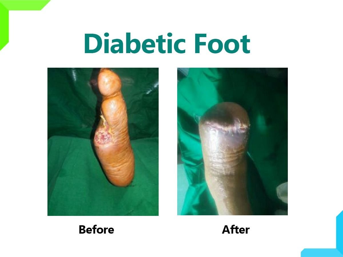 Diabetic Foot Diabetic Foot