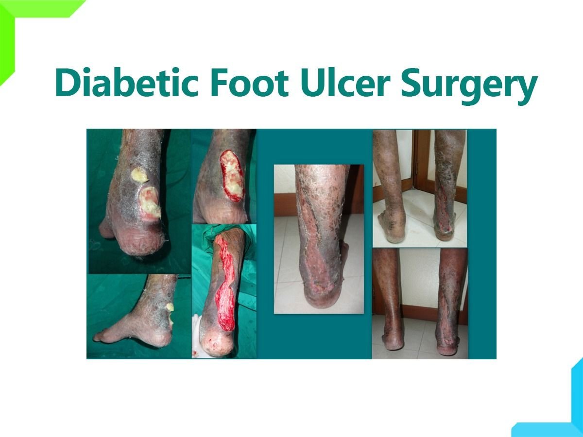 Diabetic Foot Ulcer Surgery Diabetic Foot Ulcer Surgery