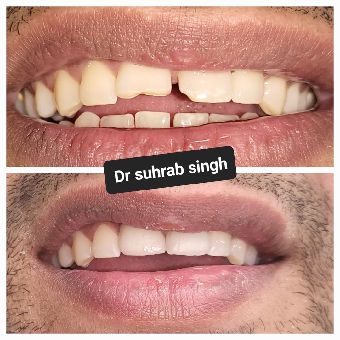 Smile designing and gap closure with emax glass veneers Smile designing and gap closure with emax glass veneers