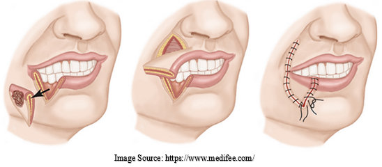 Oral Cancer Reconstruction Surgery