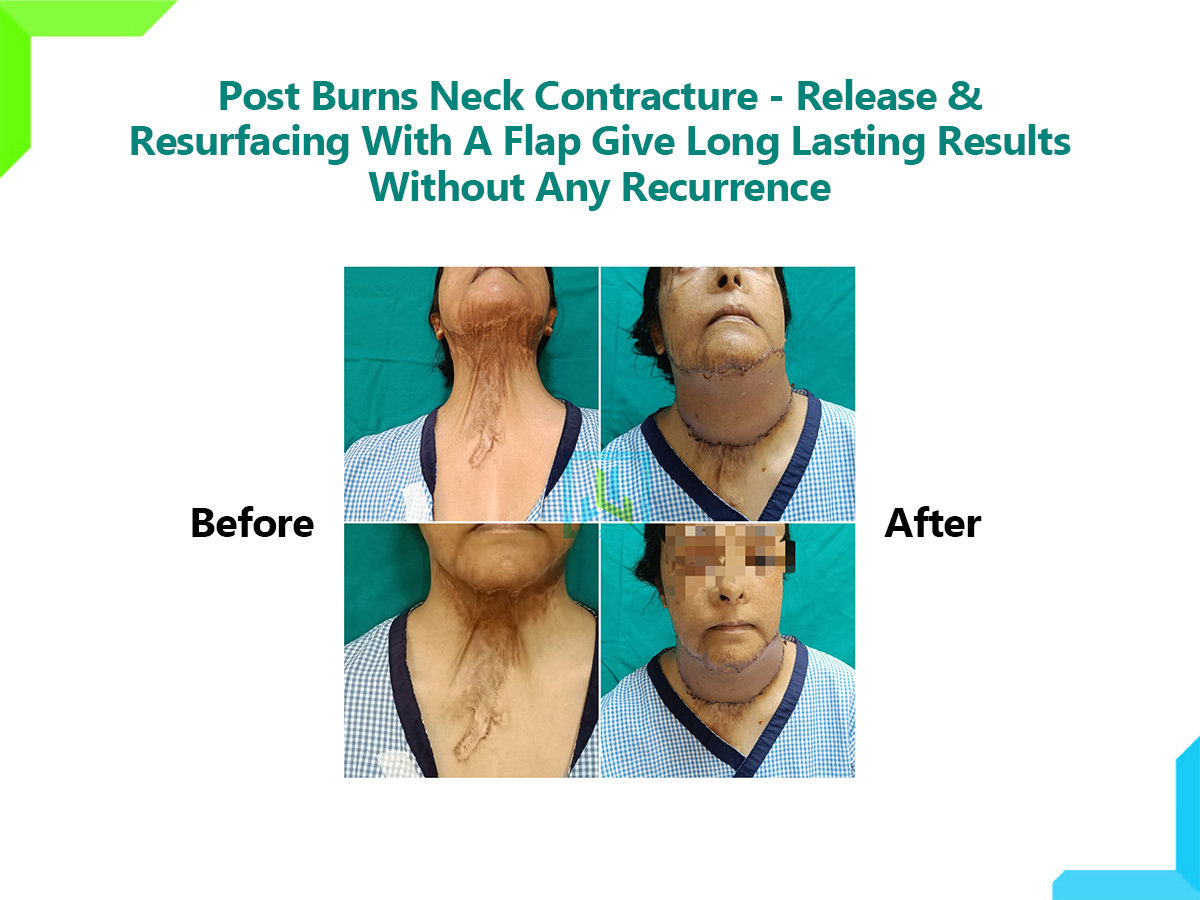 Post burns neck contracture Post burns neck contracture
