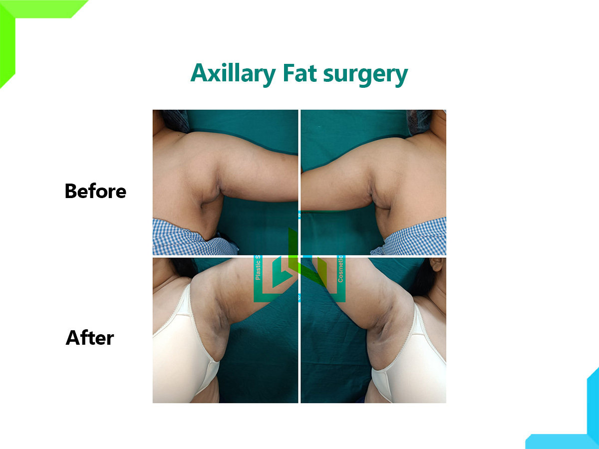Axillary Fat surgery Axillary Fat surgery