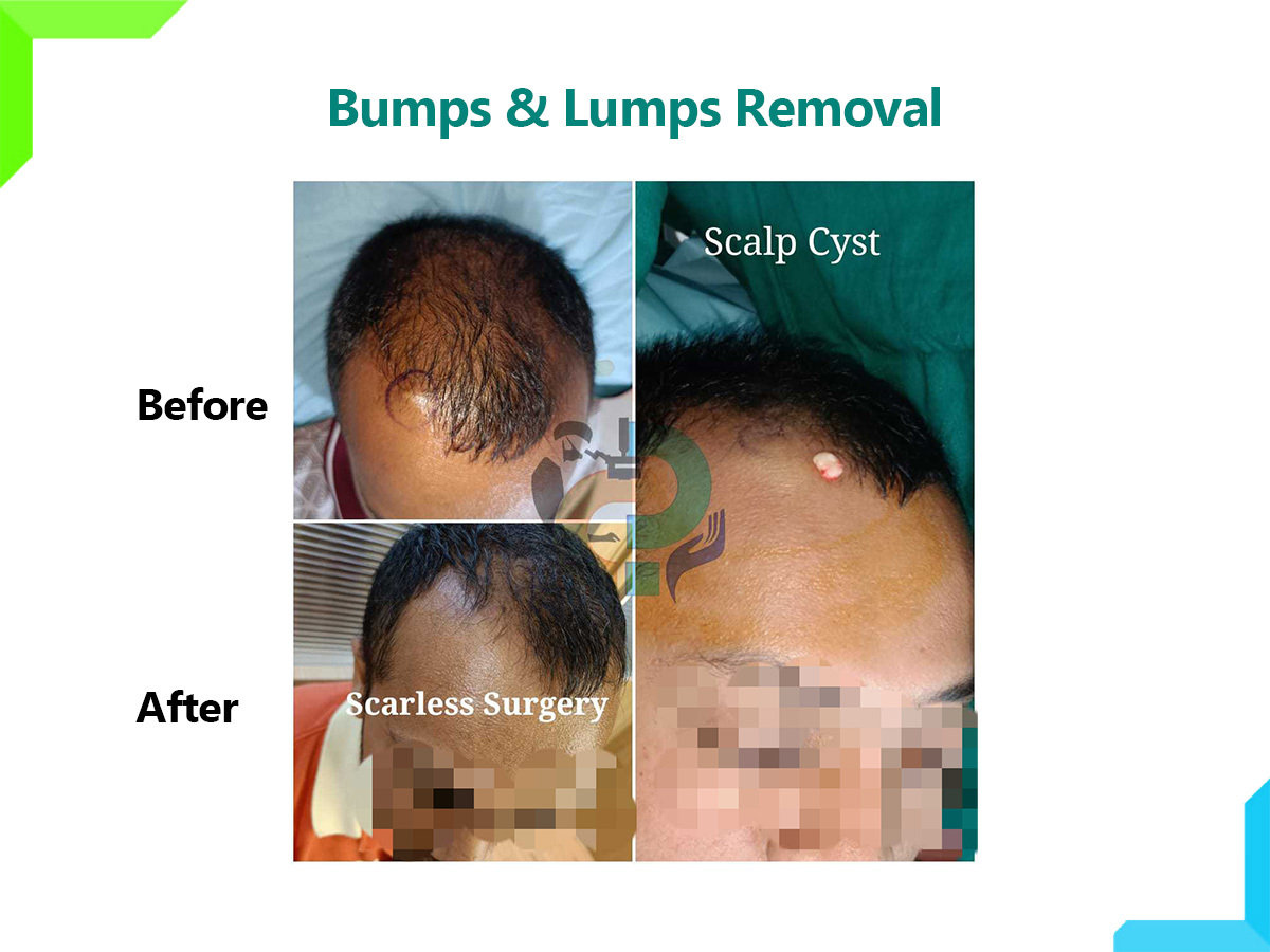 Bumps and Lumps removal Bumps and Lumps removal