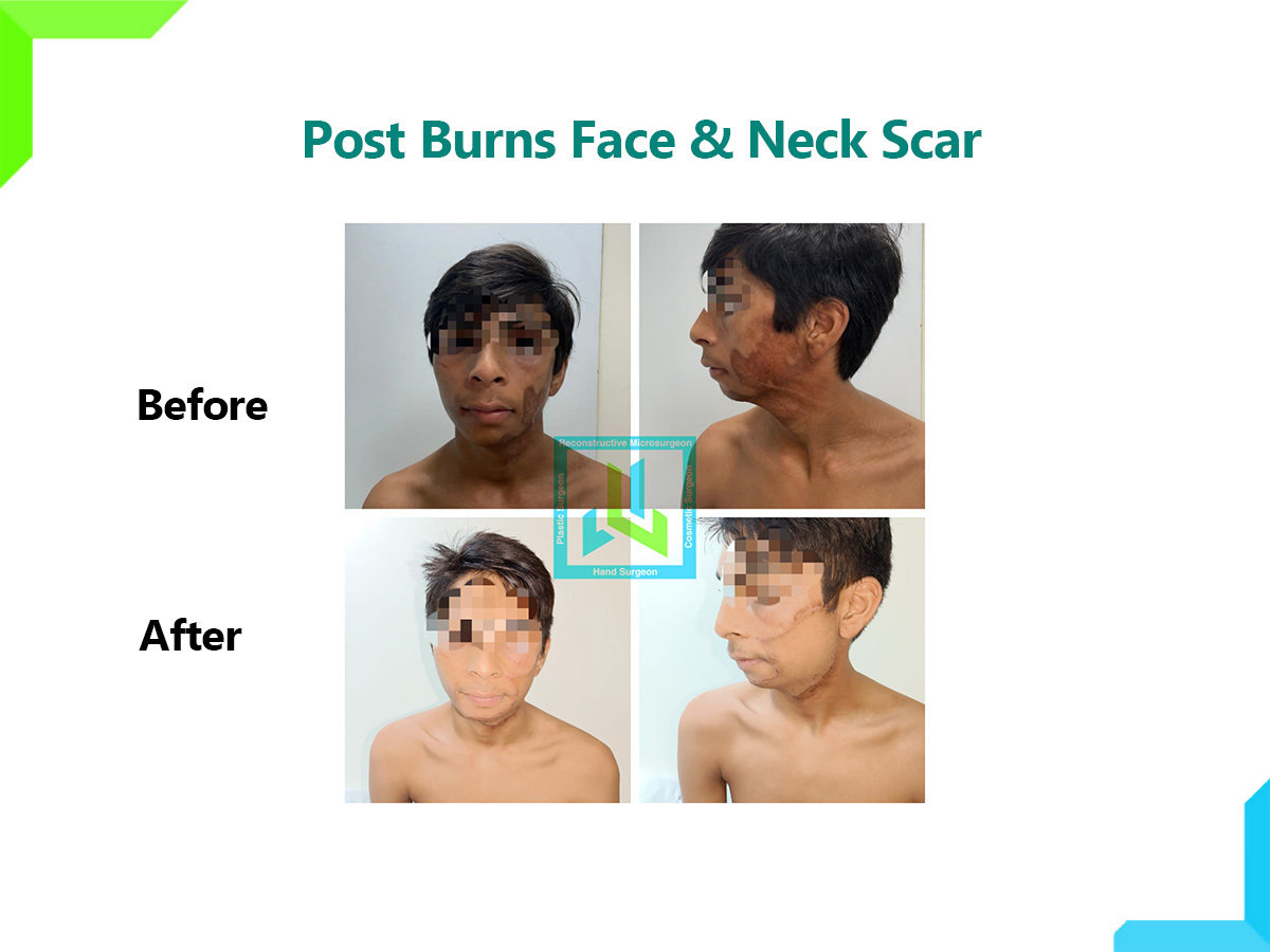 Post Burns Face and neck scar Post Burns Face and neck scar