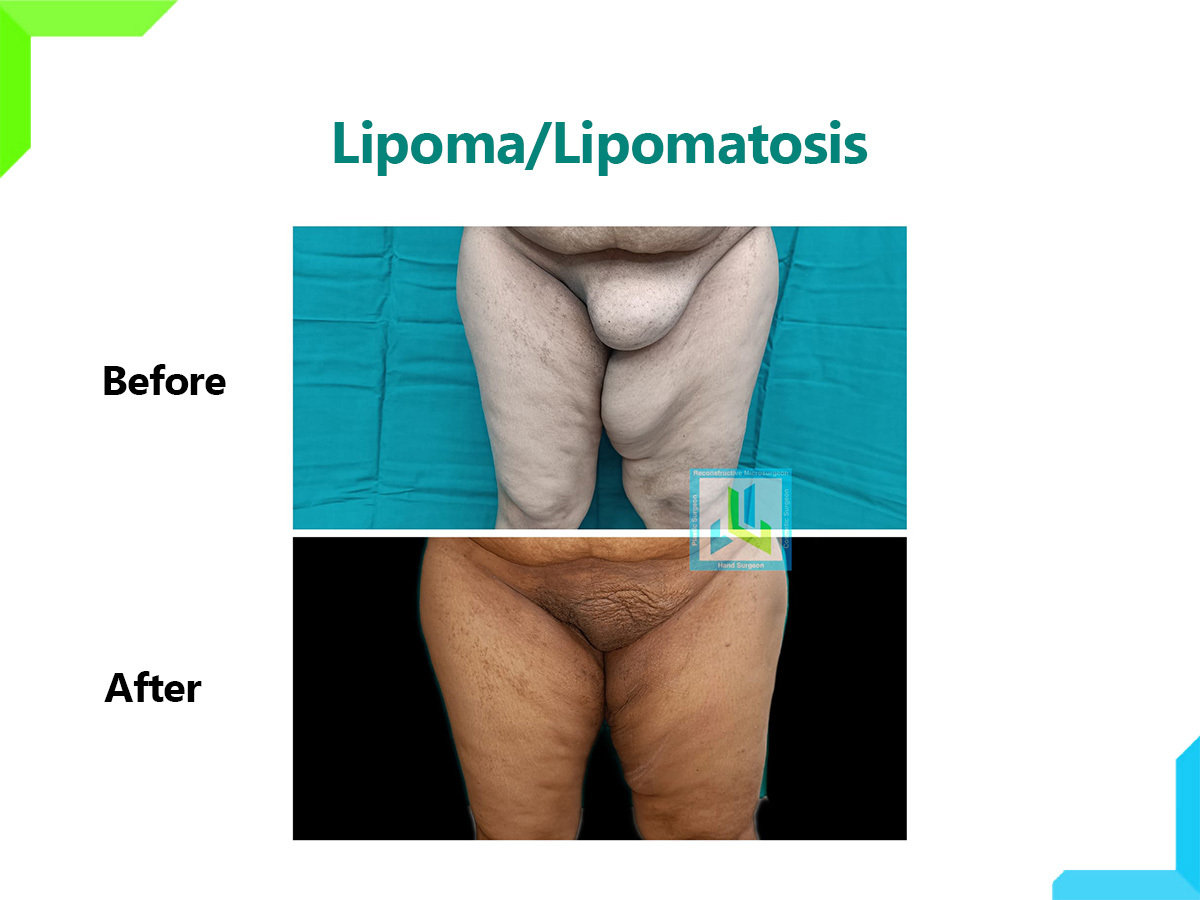 Lipoma Lipoma