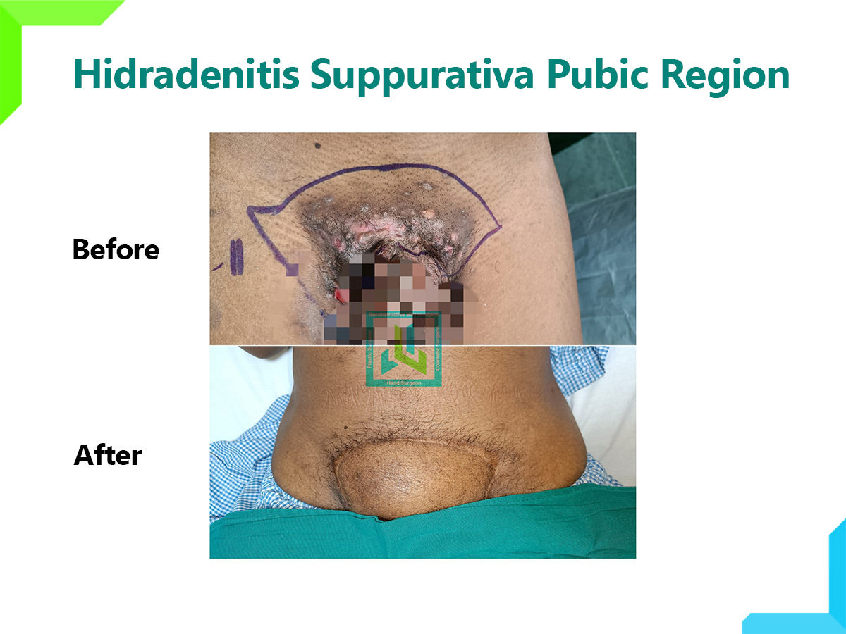 Hidradenitis suppurativa Hidradenitis suppurativa