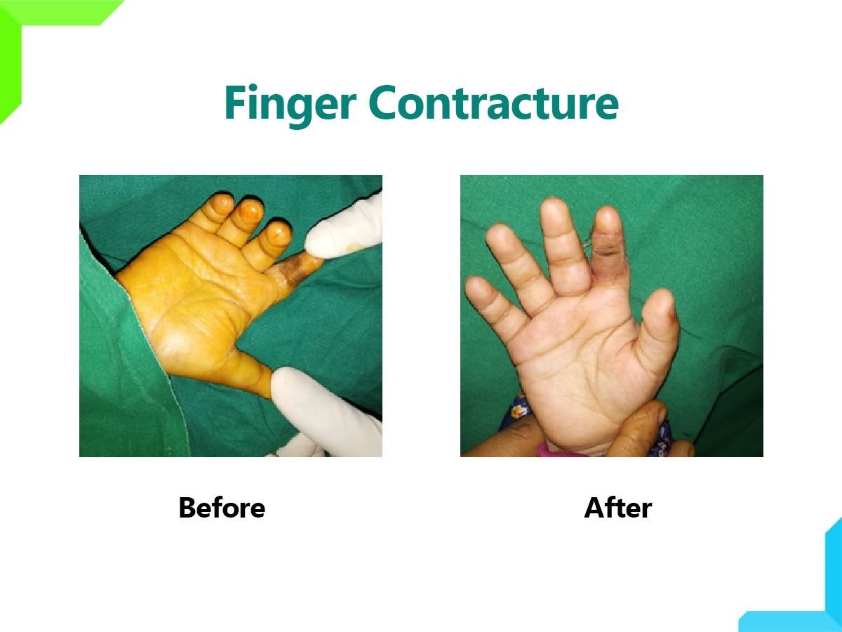Finger Contracture Finger Contracture