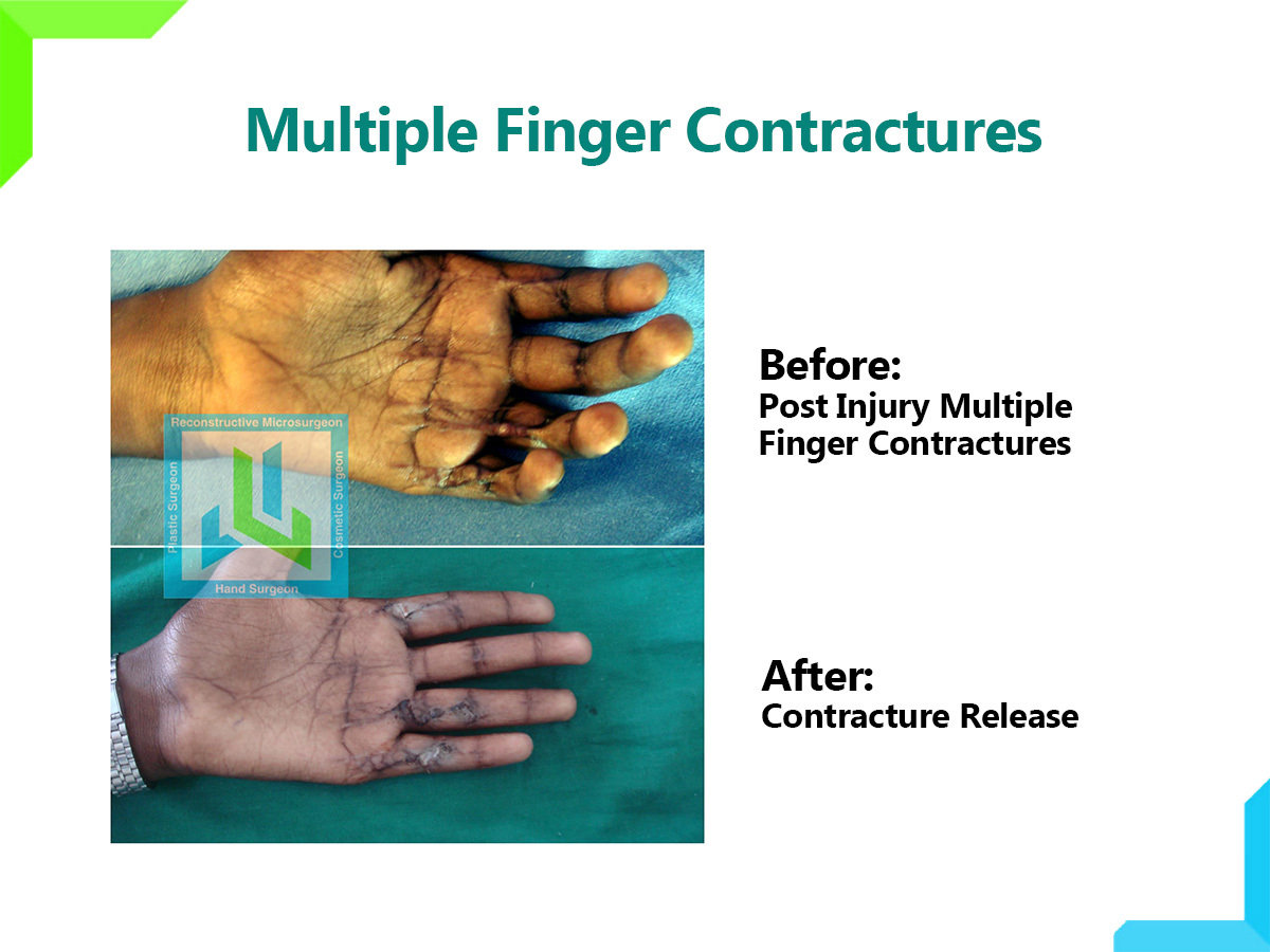 Finger Contractures. Finger Contractures.