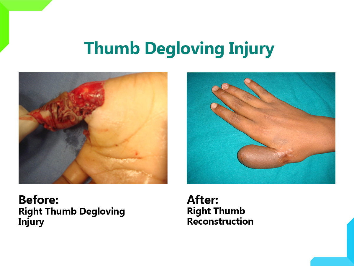Thumb Degloving Injury Thumb Degloving Injury