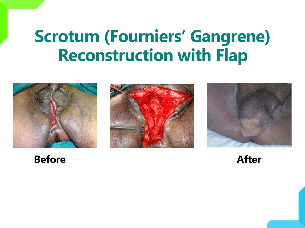 Scrotum Reconstruction Scrotum Reconstruction