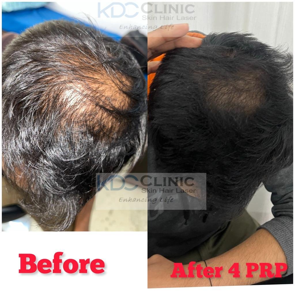 PRP hair treatment PRP hair treatment